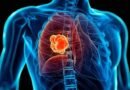Qué son los nódulos pulmonares, la lesión por la que será operado el papa León XIV